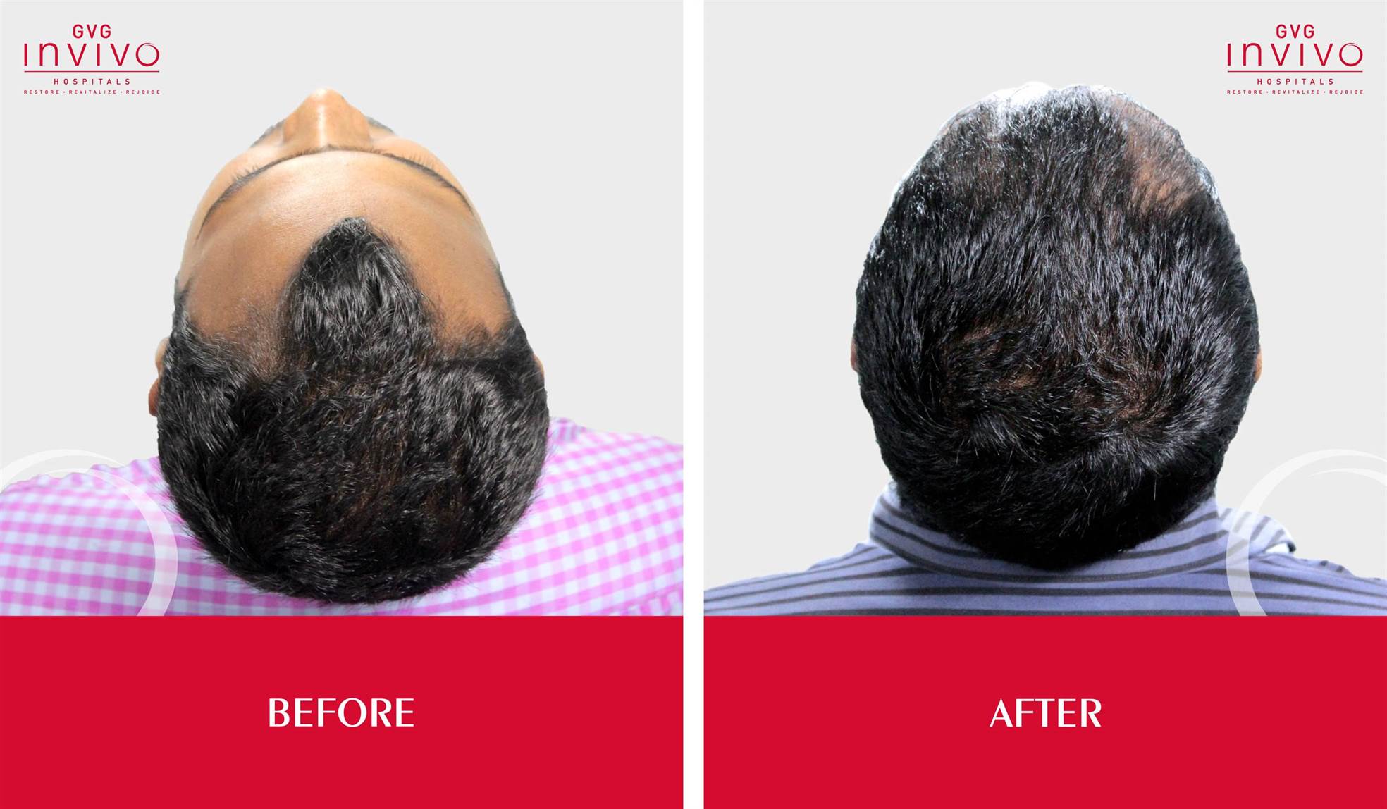 Hair Transplant Clinic In Bangalore - Performed by Expert Surgeon. Hair  transplant, Best Hair Transplant clinic in Bangalore, Hair Transplant cost  in Bangalore. hair transplant clinic near me, best hair transplantation  surgeon